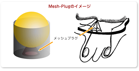 Mesh-Plug̃C[W