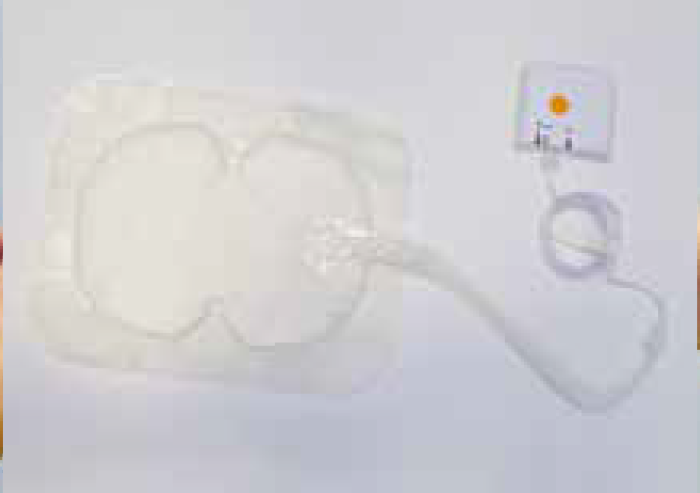 傷口に特殊なパッドを貼り、チューブでつないだ機器で陰圧をかける「陰圧閉鎖療法」。傷が回復するまで最長28日間継続